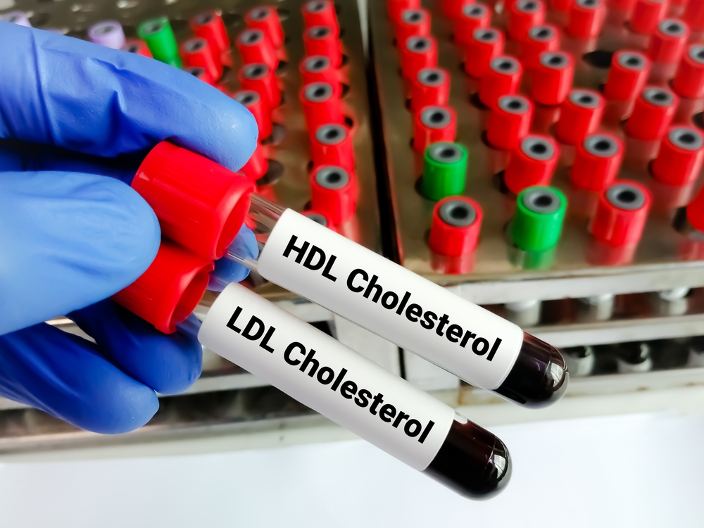 Blood samples for HDL Cholesterol (good cholesterol) and LDL Cholesterol (bad cholesterol) test, Cardiovascular disease diagnosis.