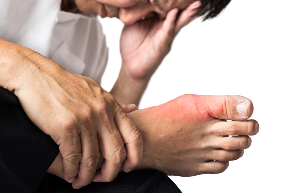Man with painful and inflamed gout on his foot around the big toe area.