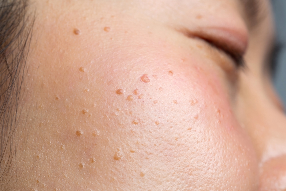 Closeup in seborrheic keratosis, pore, acne and wrinkles in face woman uneven skin. Facial care skin problems for beauty and cosmetic background concept.	