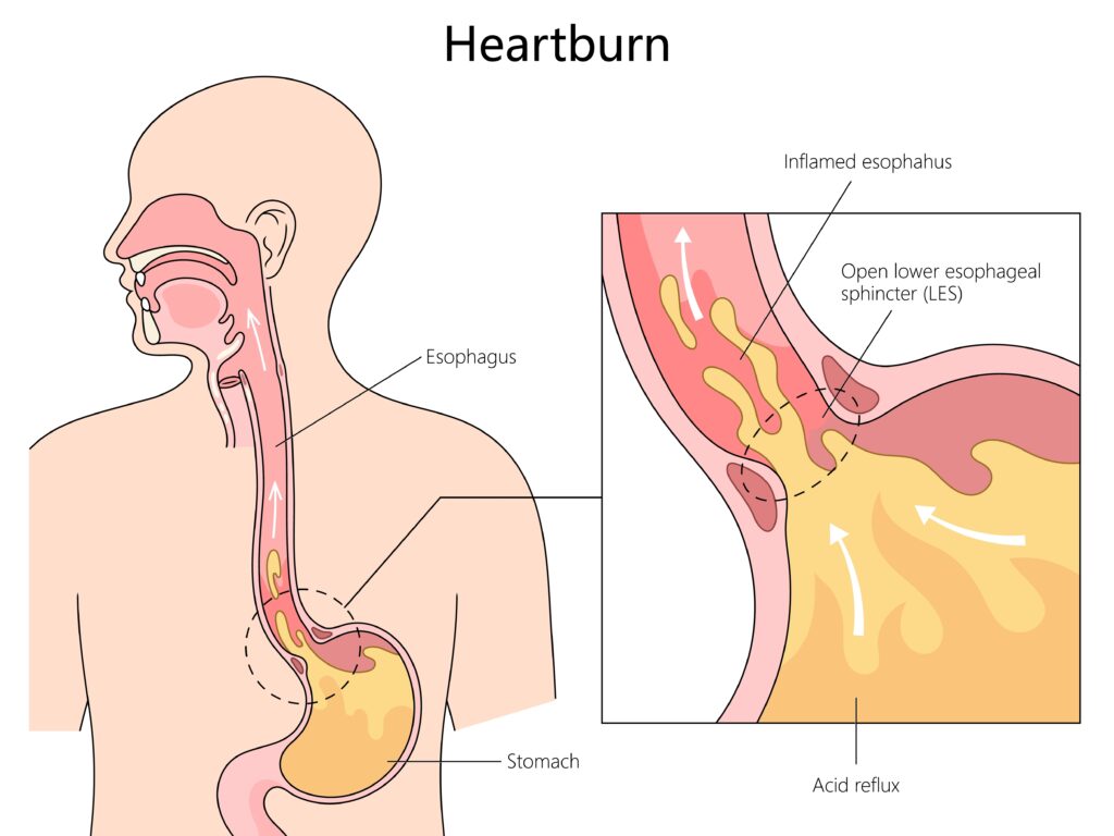anatomy of heartburn and acid reflux, with labeled parts of the esophagus and stomach diagram hand drawn schematic vector illustration. Medical science educational illustration