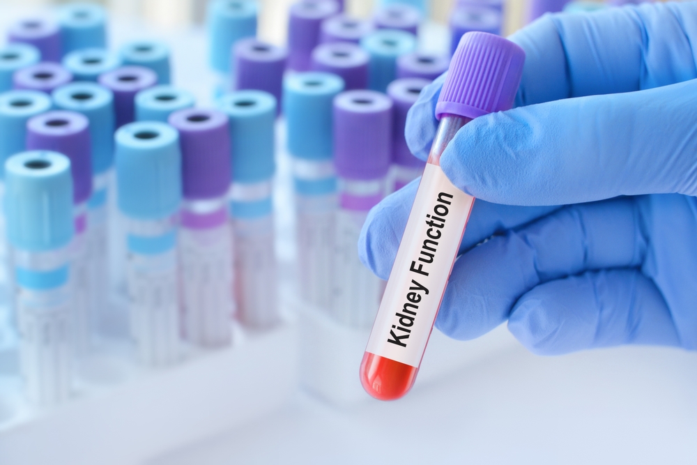 Doctor holding a test blood sample tube with Kidney Function test on the background of medical test tubes with analyzes.