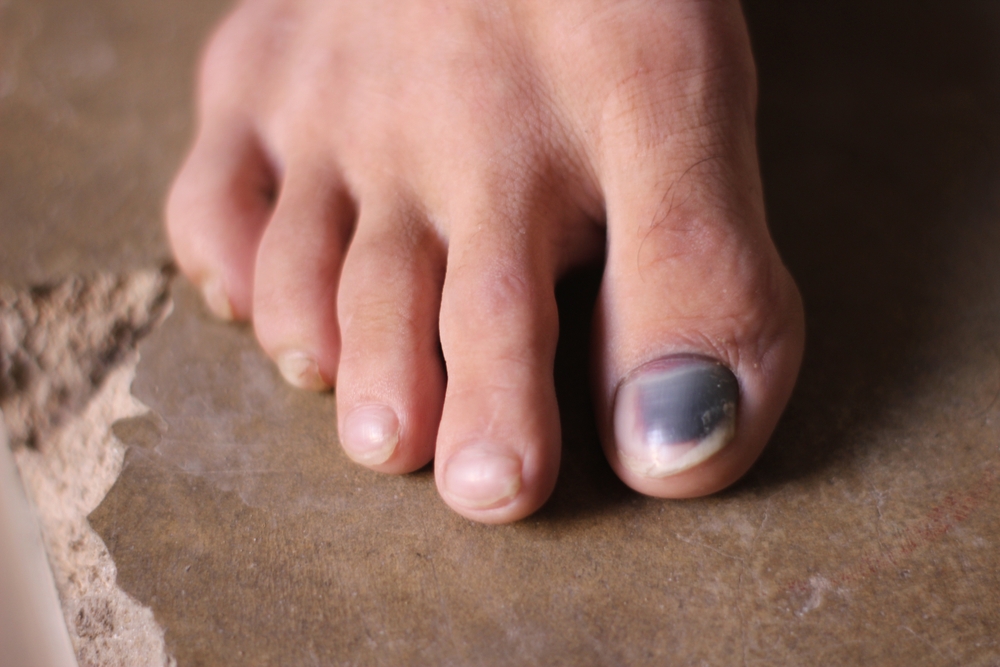 Subungual, hemorrhage, blood clot, fungal, vessels , deformed, swollen, black nail, Injured finger, finger nail, injured toe, black nail, nail fungus, infection, wound,