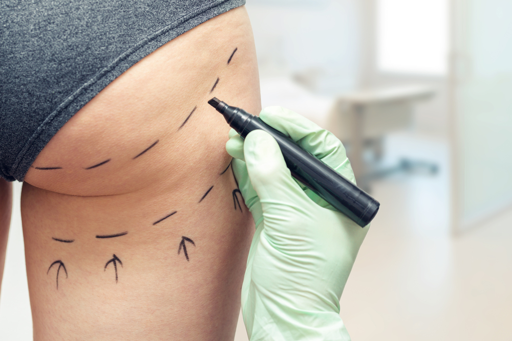 plastic surgeon marking womans body for surgery