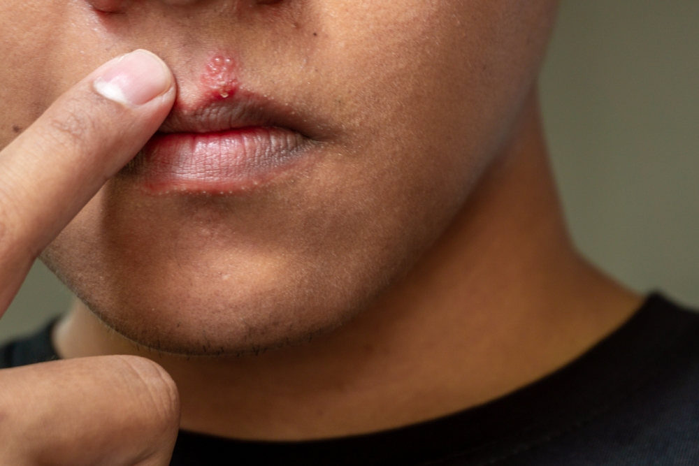 Men lips affected herpes blisters. Herpes virus and infection treatment