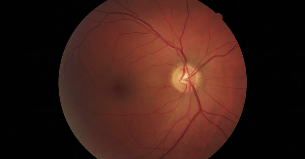 Retinal Degeneration May Be Treated With Drug Originally Developed for Alcoholism - Featured image