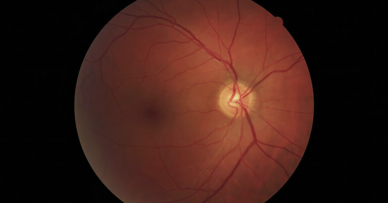 Retinal Degeneration May Be Treated With Drug Originally Developed for Alcoholism - Featured image