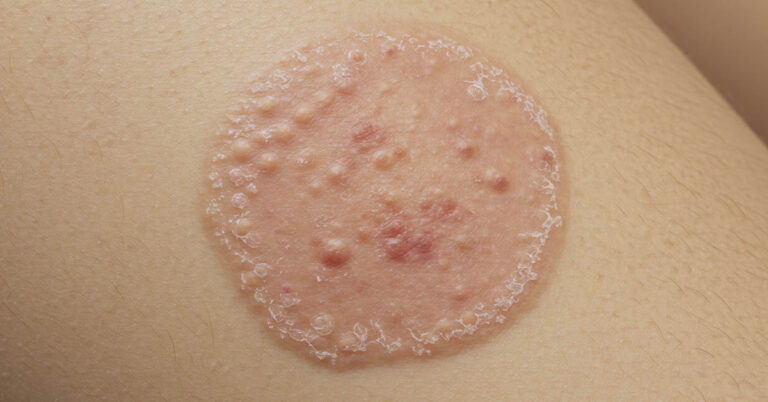 Ringworm 101: Causes, Symptoms, and Simple Remedies You Can Try at Home - Featured image