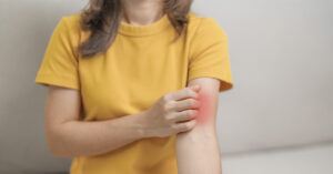 Woman scratching rash on inside of arm/elbow area