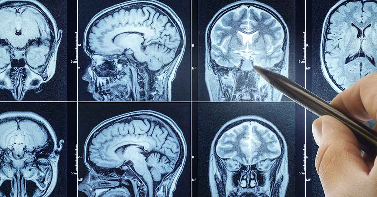 Cheap Supplements Show Early Promise Against Aggressive Brain Tumors