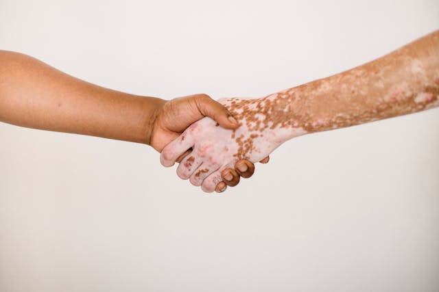 two hands shaking, one with psoriasis