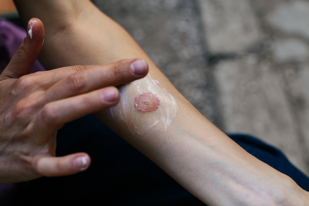 Ring Worm infection, Dermatophytosis on skin. Applying an emollient to dry flaky skin