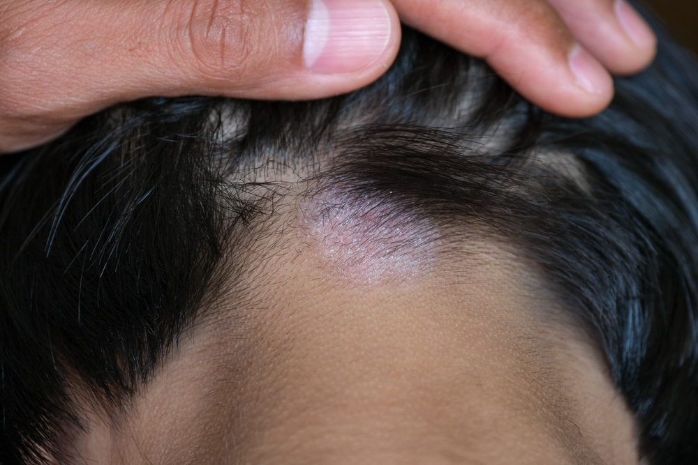 Closed up of ringworm (tinea) on head of Asian girl (Dermatitis). skin with psoriasis. Seborrheic dermatitis. Chronic inflammation on the skin) Appears as a red, itchy and scaly dandruff on the head.