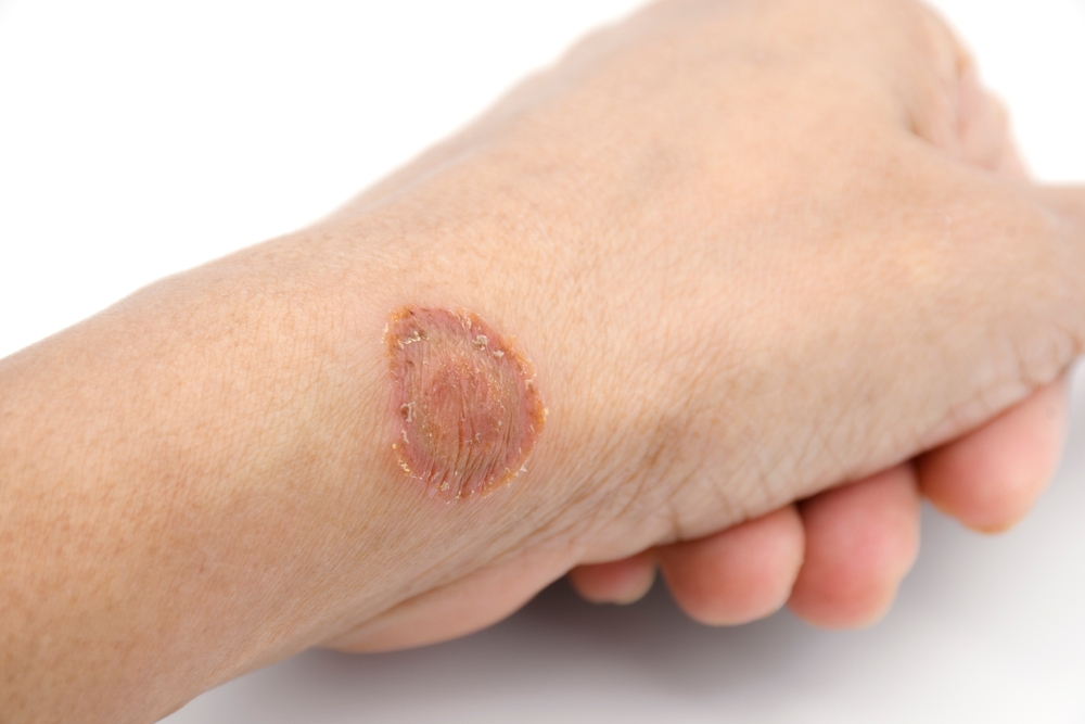 Microsporum canis lesion, a fungus infections on human skin transmitted by contact domesticated cats, and occasionally dogs or humans infected skins.