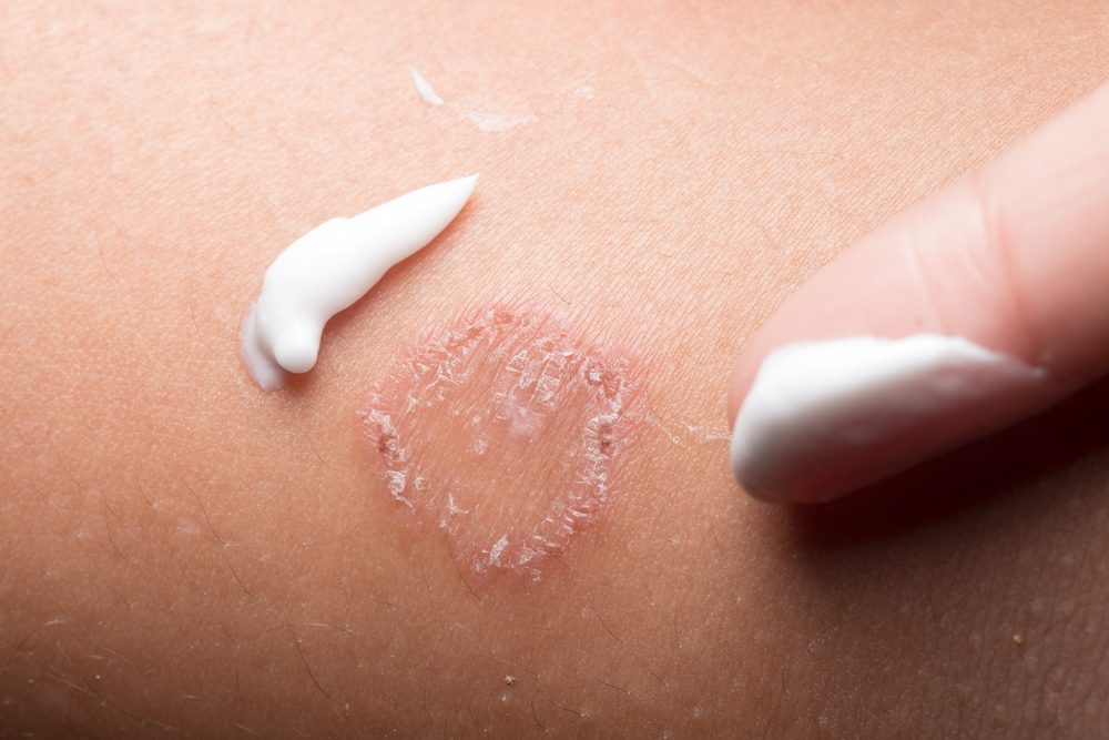 Ring Worm infection, Dermatophytosis on skin
