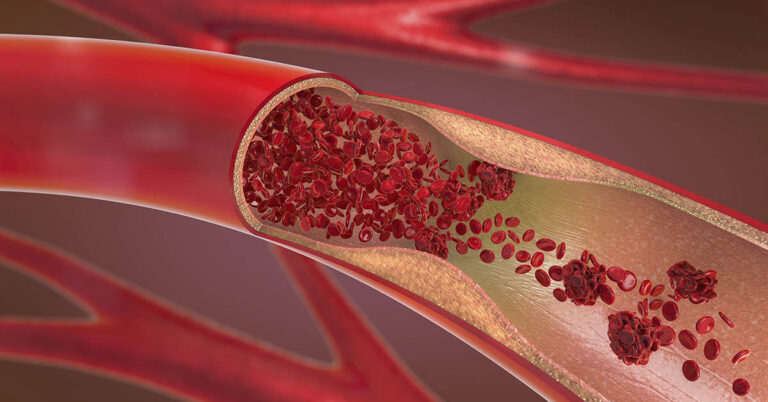 7 Subtle Blood Clot Symptoms Most People Miss - Featured image