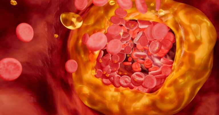 Innovative Nanoparticles Identify and Disarm Heart-Disease-Causing Plaque - Featured image