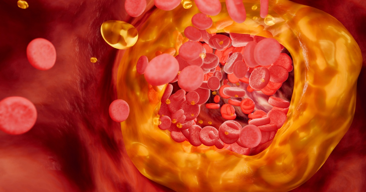 Innovative Nanoparticles Identify and Disarm Heart-Disease-Causing Plaque