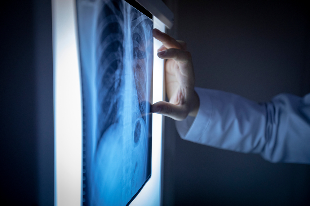 Doctor looking xray and checking lungs