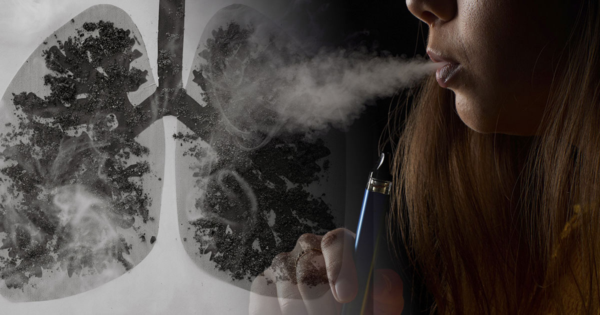 Vaping Tied to a Rare Form of Long-Term Lung Damage
