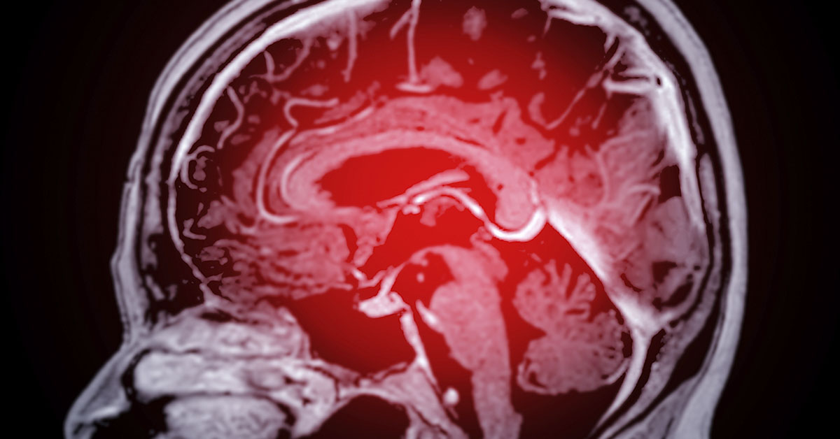 Family of 24-Year-Old Who Died From Young-Onset Dementia Share the First Symptoms They Noticed
