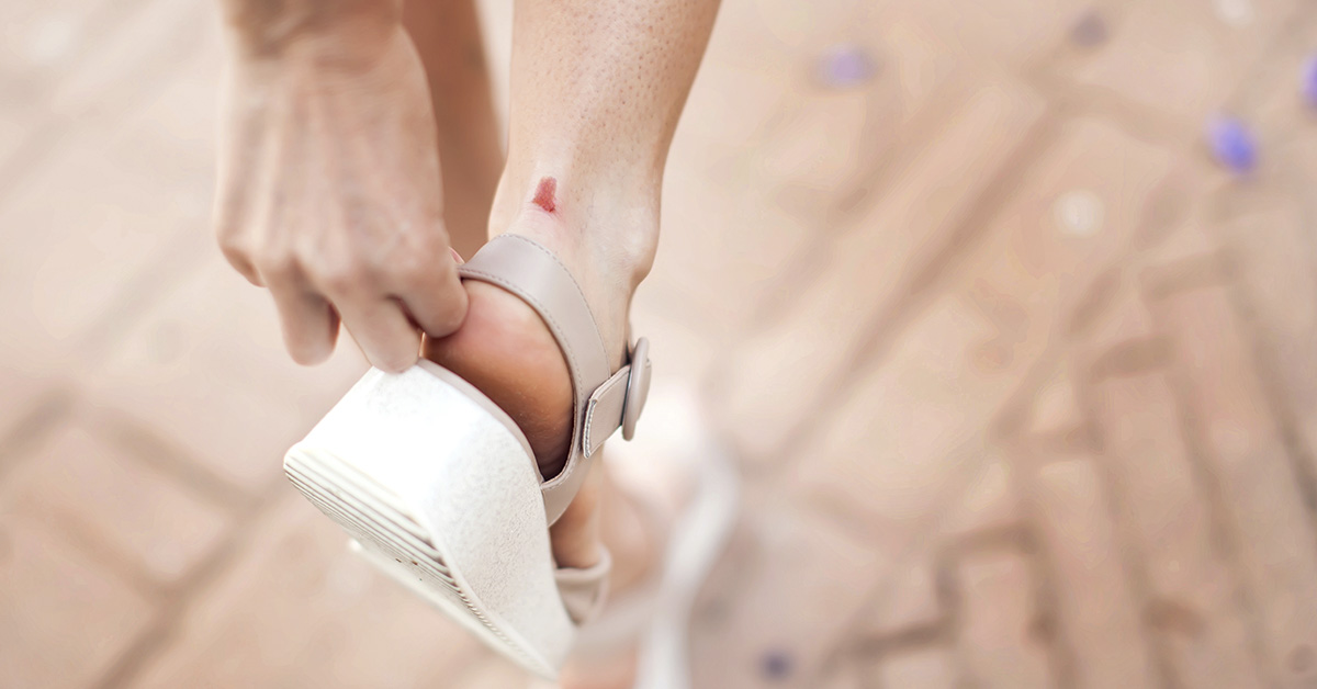 Blood Blisters: Causes, Symptoms, and When to See a Doctor