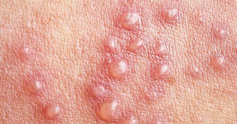 The Virus That Lurks for Years Until Your Body Can No Longer Keep It in Check - Featured image