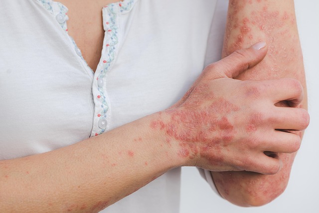 man with psoriasis