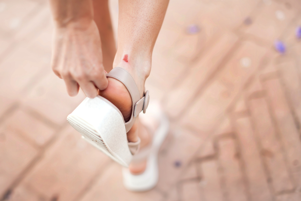 Callus on the heel of woman outdoor. Healthcare and medicine concept