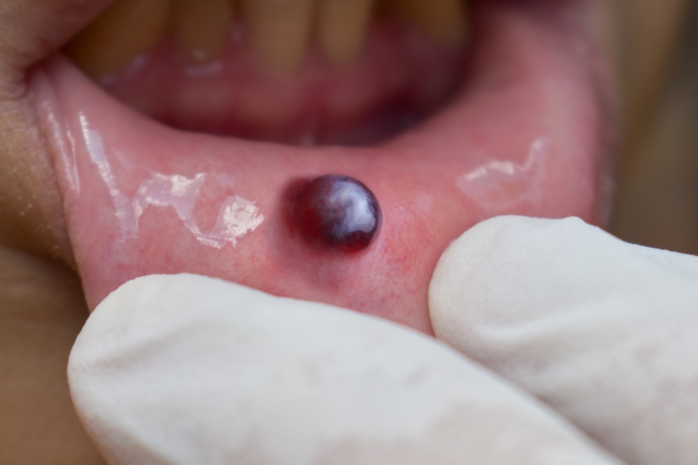 Blood cyst or dark mucocele in lower lip of Asian man. Caused by accidental bite. Closeup view