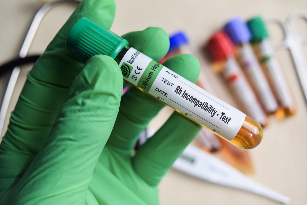 Rh Incompatibility - Test with blood sample in green gloved hands. healthcare or Medical concept. Bekasi, Indonesia, July 2, 2025