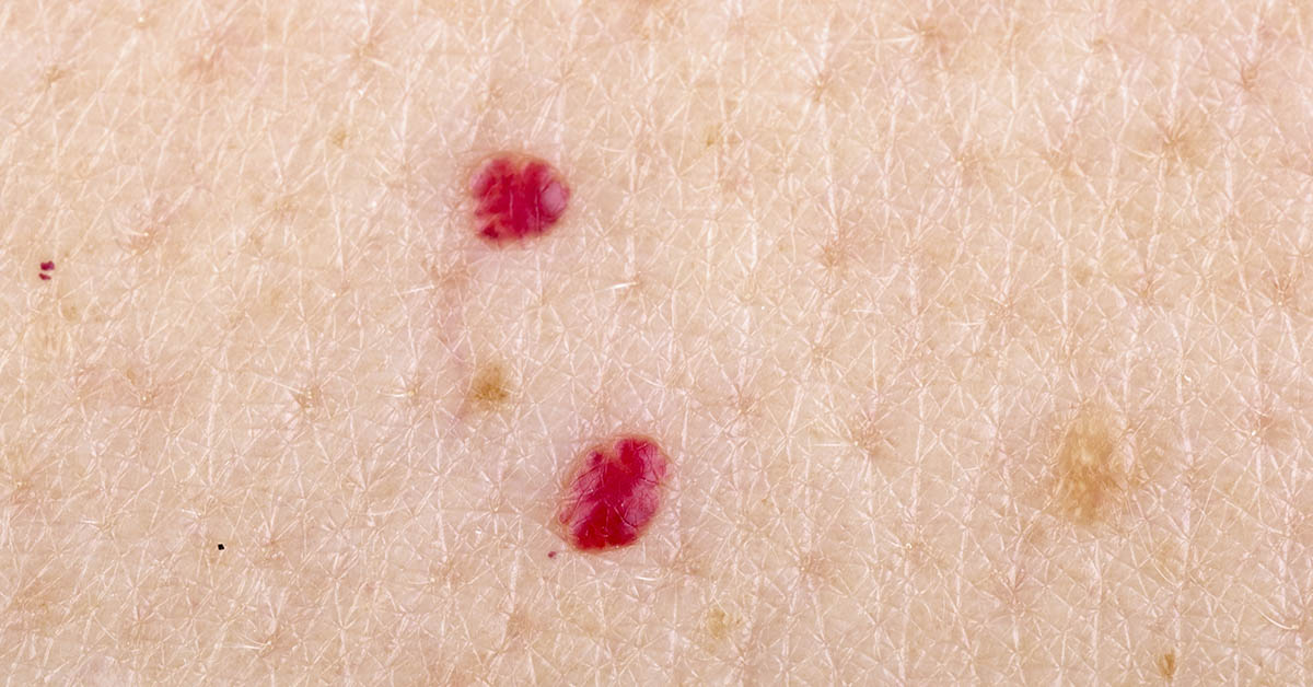 Noticing Tiny Red Dots on Your Skin? Here’s What a Dermatologist Wants You to Know