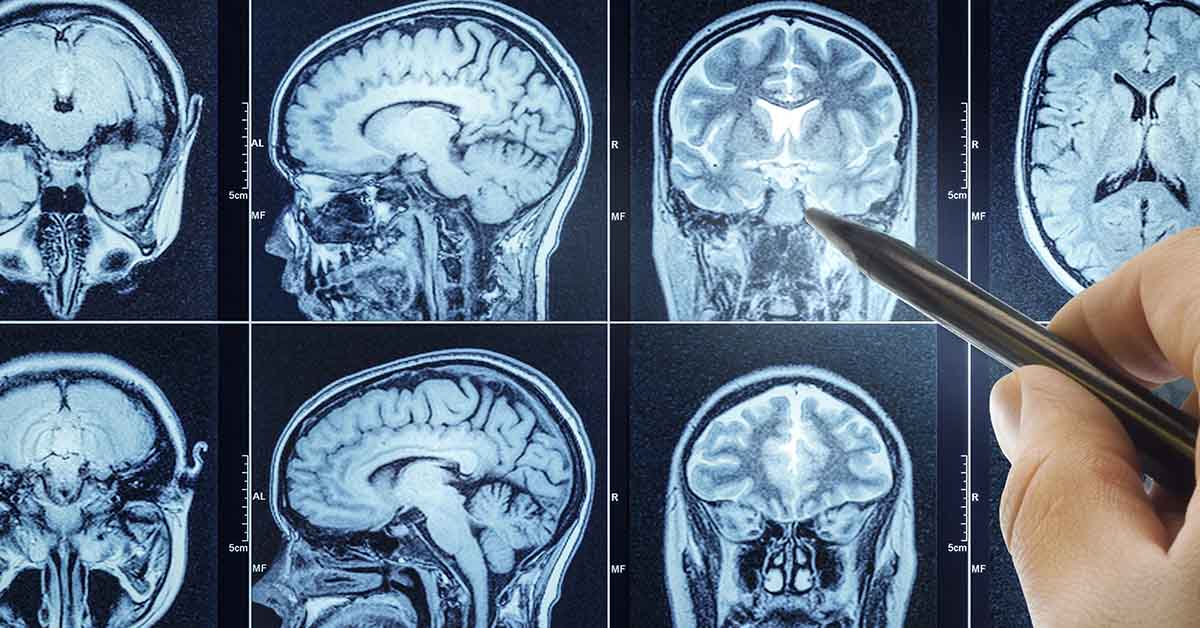 Dad Told He Has “Days Left to Live” After 10 Years of Headaches Were Dismissed