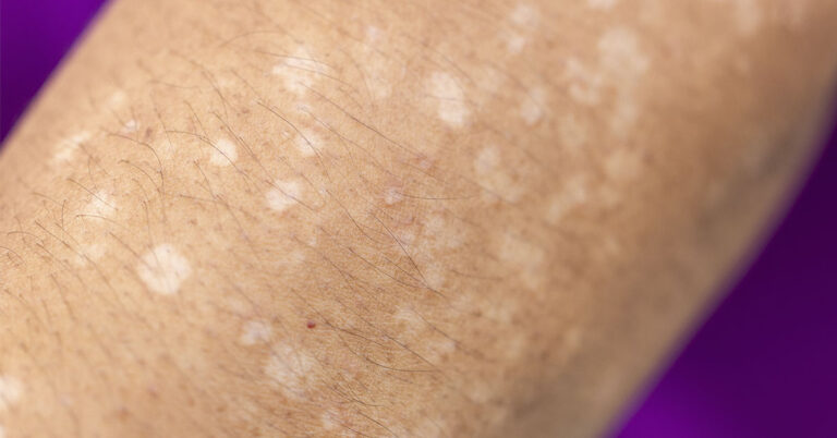 Noticing Small White Spots on Your Arms or Legs? Here’s What They Could Mean - Featured image