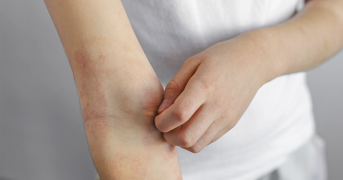 8 Surprising Hives Triggers You Might Be Overlooking