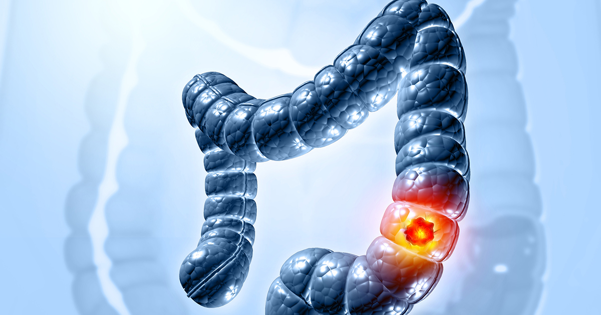 Mrinali Dhembla Declared Cancer-Free After Stage 6 Rectal Cancer Immunotherapy Treatment at 26