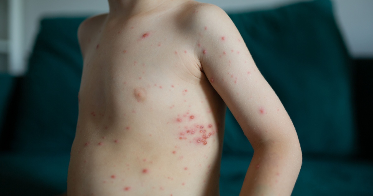 The Childhood Virus Silently Linked to Dementia — And What to Do About It