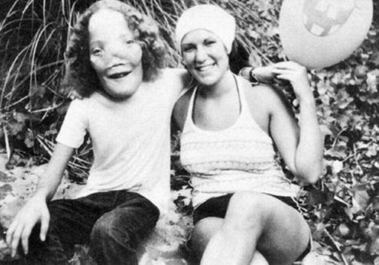 Rocky Dennis: The True Story Behind the Film Mask - Featured image