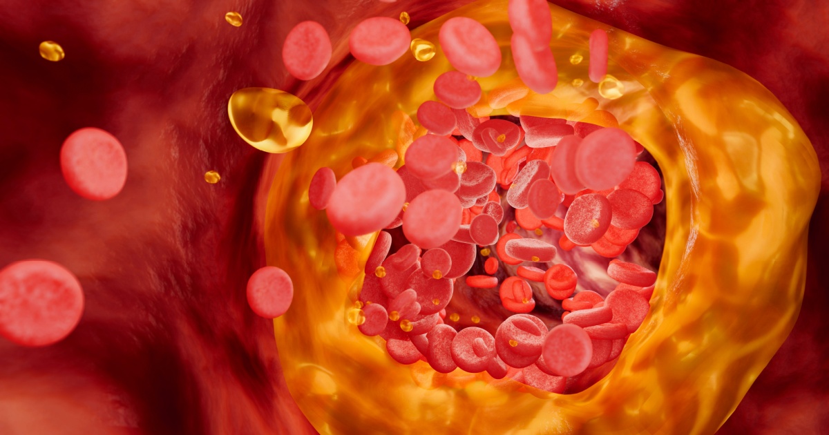Scientists Are Experimenting With Immunotherapy to Fight Deadly Artery Plaque