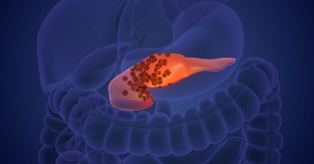 The Pancreatic Cancer Pill That Made Oncologists Stand Up and Cheer - Featured image