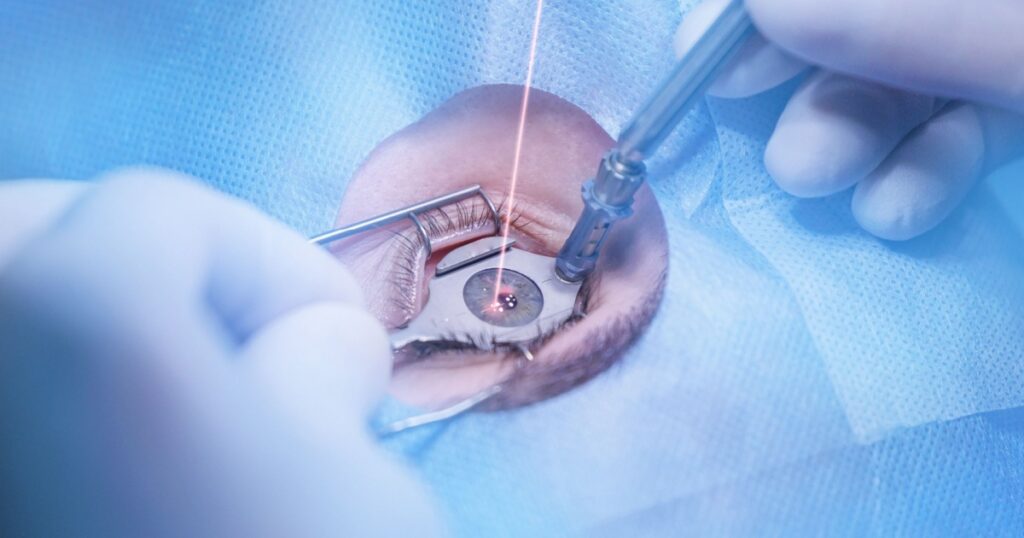 The Dark Side of LASIK That People Should Know About - Featured image