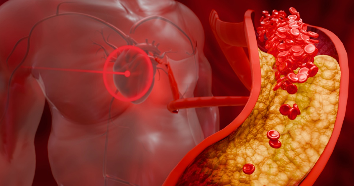 Study Suggests ‘Silent’ Inflammation Could Be a Driver of Heart Disease