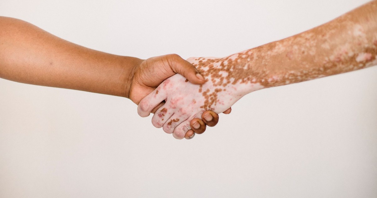 Crop anonymous man shaking hand of male friend with vitiligo skin against white background