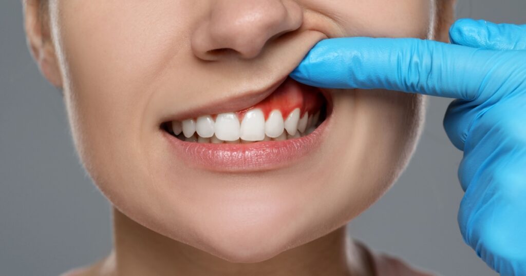 A Fasting Mimicking Diet Reduced Gum Disease — Here’s What the Trial Found - Featured image