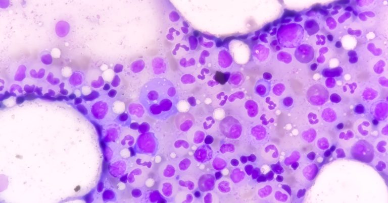 The New Rule That’s Changing How Doctors Catch the Deadliest Myeloma - Featured image