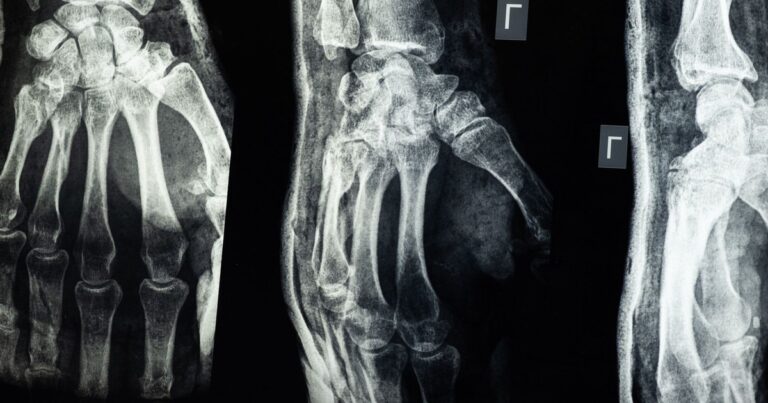 Missed Fracture Warning Signs May Leave People With Undiagnosed Bone Disease - Featured image