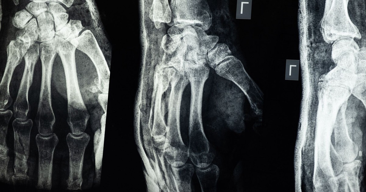 Missed Fracture Warning Signs May Leave People With Undiagnosed Bone Disease