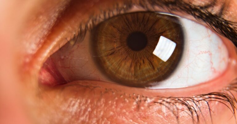 Woman’s Cornea Destroyed by Parasite After Contact Lens Mistake - Featured image